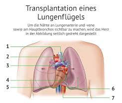 lungentransplantation