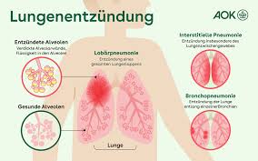 lungenentzündungen