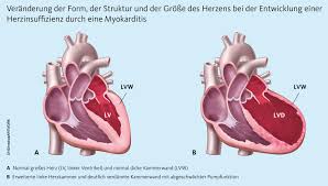 herzmuskelentzündung